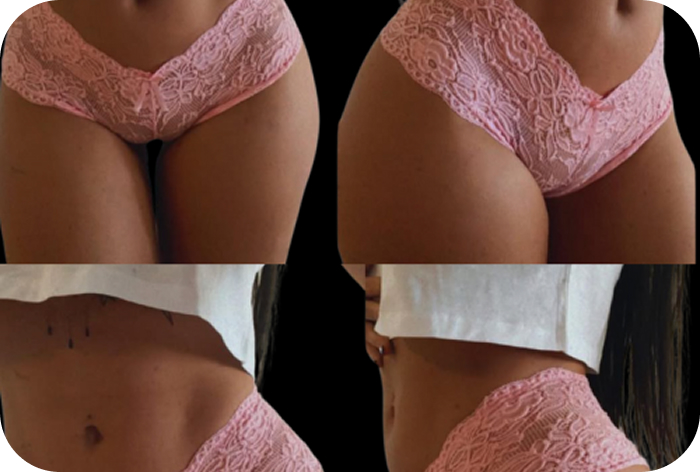 After liposuction image showing a slimmer waistline and contoured body