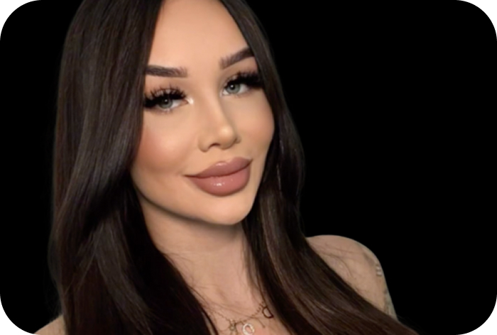 After rhinoplasty photo highlighting a reshaped and refined nose